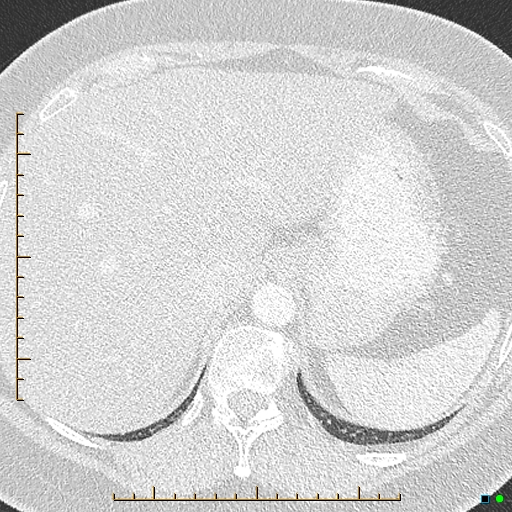 File:Bronchial diverticula (Radiopaedia 79512-92676 Axial lung window 202).jpg