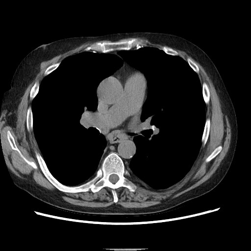 Bronchial stenosis - lung transplant (Radiopaedia 73133-83848 Axial non-contrast 31).jpg
