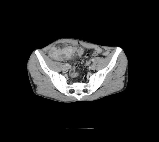 File:Bronchiectasis in Crohn disease (Radiopaedia 60311-67977 B 143).jpg