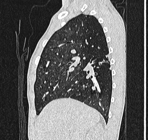 Bronchiolitis obliterans (Radiopaedia 71538-81897 Sagittal lung window 19).jpg