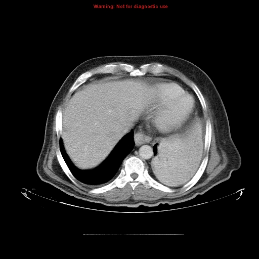 File:Bronchioloalveolar carcinoma (Radiopaedia 9272-9955 A 25).jpg