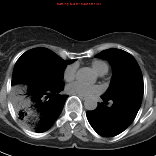 File:Bronchoalveolar carcinoma (BAC) (Radiopaedia 13436-13392 Axial non-contrast 30).jpg