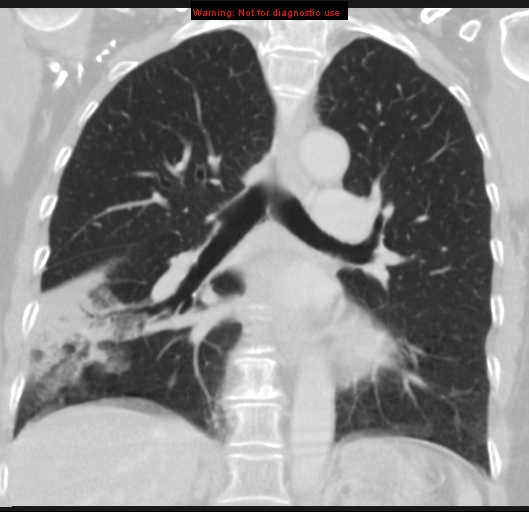 Bronchoalveolar carcinoma (BAC) (Radiopaedia 13436-13392 Coronal lung window 33).jpg