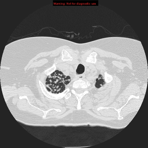 File:Bronchoalveolar carcinoma (Radiopaedia 13224-13233 B 1).jpg