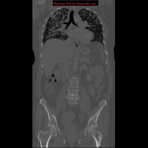 File:Bronchoalveolar carcinoma (Radiopaedia 13224-13233 Coronal non-contrast 10).jpg