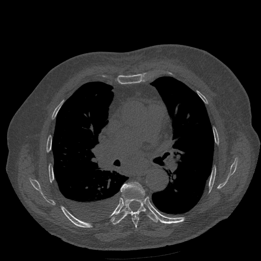 Bronchogenic carcinoma with metastatic lymphadenopathy (Radiopaedia 37671-39569 Axial bone window 27).jpg