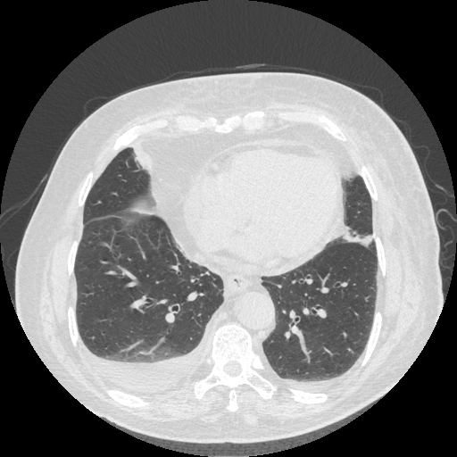 Bronchogenic carcinoma with metastatic lymphadenopathy (Radiopaedia 37671-39569 Axial lung window 39).jpg