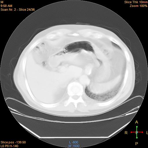File:Bronchogenic carcinoma with superior vena caval invasion (Radiopaedia 22378-22406 lung window 21).jpg