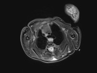 File:Bronchogenic cyst (Radiopaedia 27207-27380 Axial STIR 12).jpg
