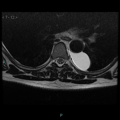 File:Bronchogenic cyst - posterior mediastinal (Radiopaedia 43885-47365 Axial T2 12).jpg