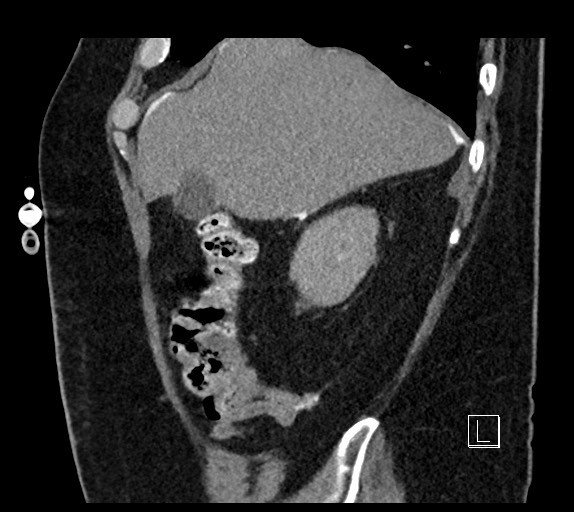 Buried bumper syndrome - gastrostomy tube (Radiopaedia 63843-72577 Sagittal Inject 96).jpg