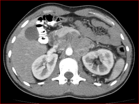 File:Burned-out testicular choriocarcinoma (Radiopaedia 32822-34040 B 5).PNG