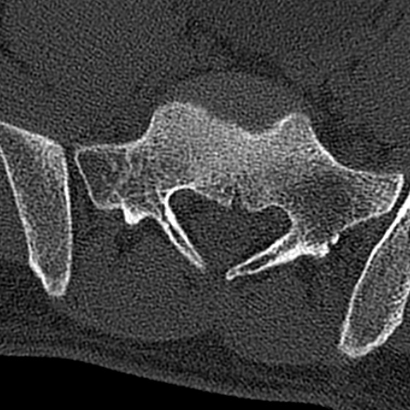 Burst fracture (Radiopaedia 53373-59357 Axial bone window 69).jpg