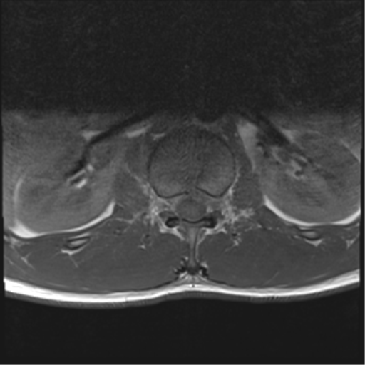 File:Burst fracture - T12 with conus compression (Radiopaedia 56825-63646 Axial T1 12).png