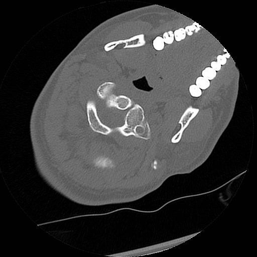C1-C2 "subluxation" - normal cervical anatomy at maximum head rotation (Radiopaedia 42483-45607 Axial non-contrast 49).jpg