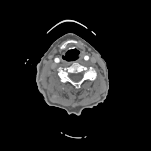 File:C2 fracture with vertebral artery dissection (Radiopaedia 37378-39200 A 129).png
