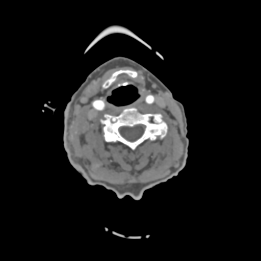 File:C2 fracture with vertebral artery dissection (Radiopaedia 37378-39200 A 132).png