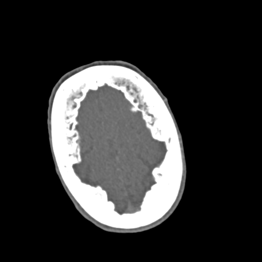 File:C2 fracture with vertebral artery dissection (Radiopaedia 37378-39200 A 294).png