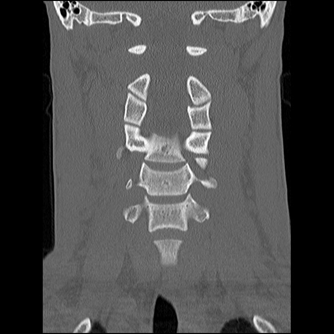 C5 facet fracture (Radiopaedia 58374-65499 Coronal bone window 29).jpg