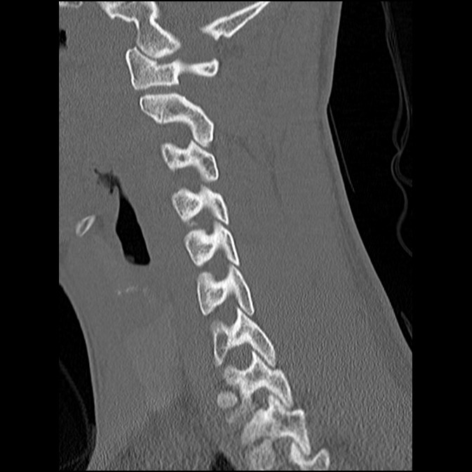 C5 facet fracture (Radiopaedia 58374-65499 Sagittal bone window 44).jpg