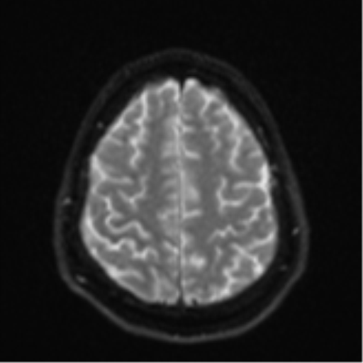 File:CNS vasculitis (Radiopaedia 55715-62263 Axial DWI 24).png