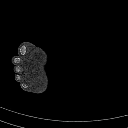 Calcaneal fracture - Sanders type 4 (Radiopaedia 90179-107370 Axial bone window 66).jpg