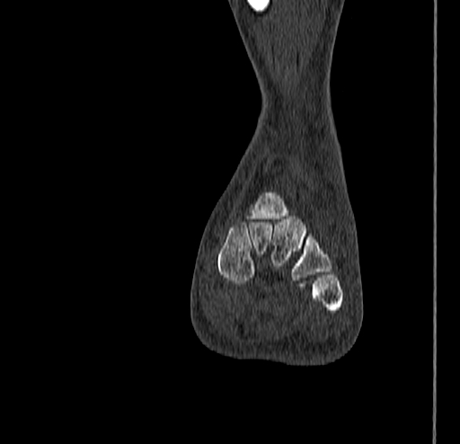 Calcaneal fracture - Sanders type 4 (Radiopaedia 90179-107370 Coronal bone window 48).jpg