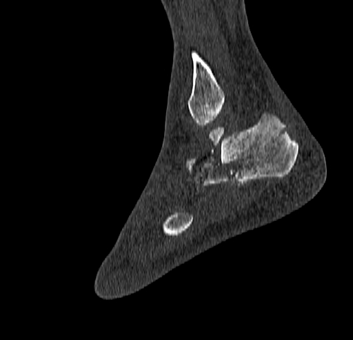 Calcaneal fracture - Sanders type 4 (Radiopaedia 90179-107370 Sagittal bone window 68).jpg