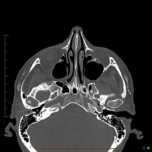 Calcified facial augmentation fillers (Radiopaedia 79514-92679 Axial bone window 9).jpg