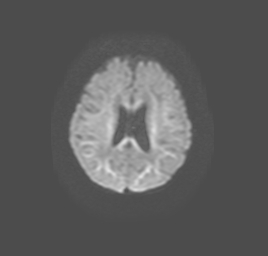 File:Canavan disease (Radiopaedia 26381-26515 Axial DWI 14).jpg