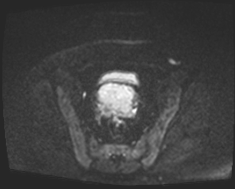 Cancer cervix - stage IIb (Radiopaedia 75411-86615 Axial DWI 47).jpg