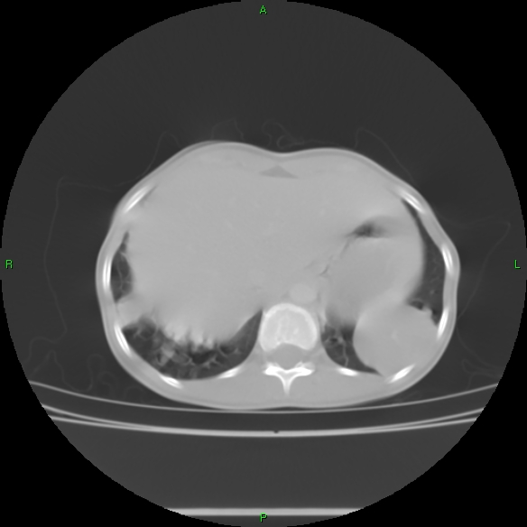 File:Cannon ball metastases - synovial sarcoma (Radiopaedia 26135-26271 Axial lung window 33).jpg
