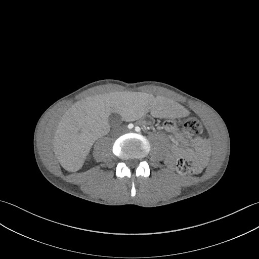 Cannonball metastases - testicular choriocarcinoma (Radiopaedia 84510-99891 B 142).jpg