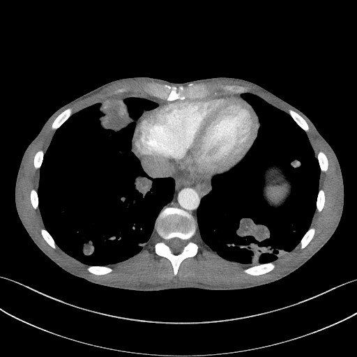 Cannonball metastases - testicular choriocarcinoma (Radiopaedia 84510-99891 B 84).jpg