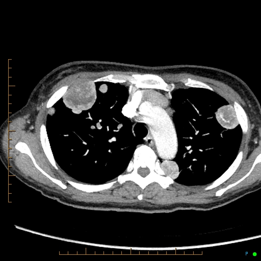 File:Canonball lung metastasis (Radiopaedia 77634-89837 B 25).jpg