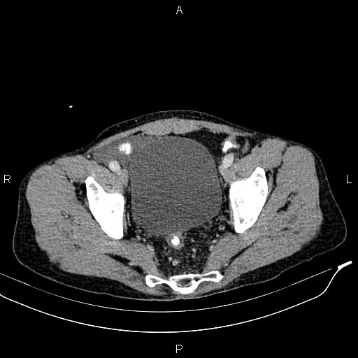 File:Caput medusae sign - portal hypertension (Radiopaedia 64007-72759 A 88).jpg