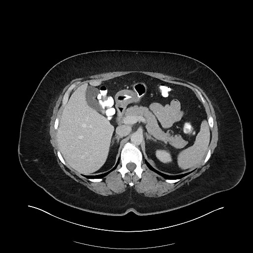 Carcinoid tumor - terminal ileum (Radiopaedia 60931-68739 A 39).jpg