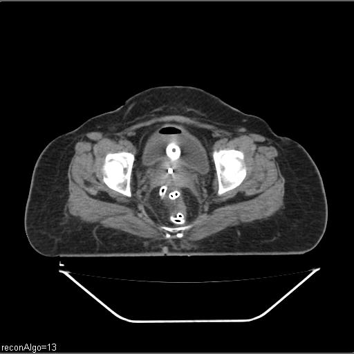 File:Carcinoma cervix- brachytherapy applicator (Radiopaedia 33135-34173 Axial non-contrast 31).jpg