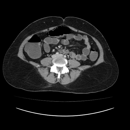 Carcinoma colon - hepatic flexure (Radiopaedia 19461-19493 A 80).jpg