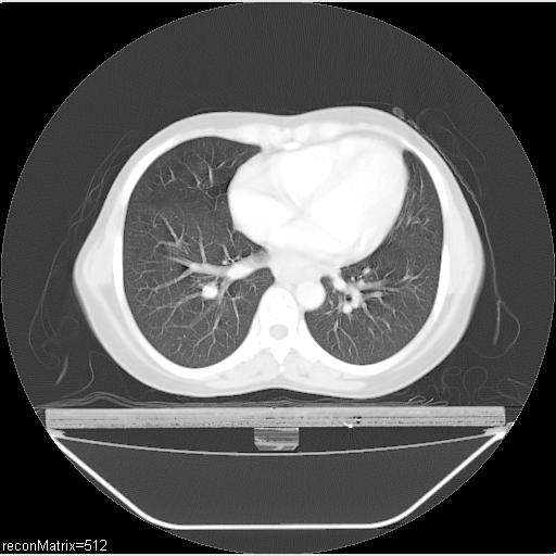 File:Carcinoma of esophagus (Radiopaedia 27356-27550 Axial lung window 14).jpg