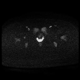 Carcinoma of the cervix (Radiopaedia 89018-105858 Axial DWI 48).jpg