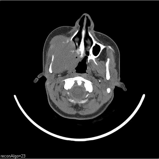 Carcinoma of the maxillary antrum (Radiopaedia 53805-59888 Axial non-contrast 56).jpg