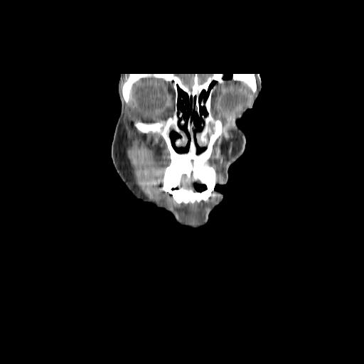 Carcinoma of the maxillary antrum (Radiopaedia 53805-59888 Coronal C+ delayed 17).jpg