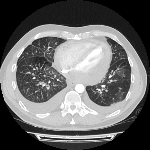 Cardiac tamponade (Radiopaedia 78607-91368 Axial lung window 61).jpg