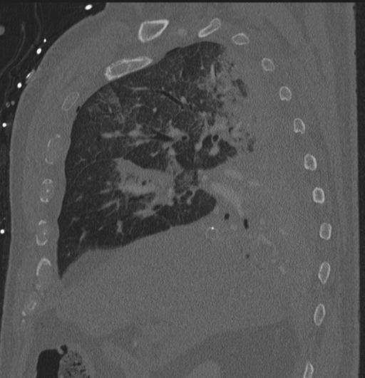 Cardiac trauma (Radiopaedia 32874-33858 Sagittal bone window 81).jpg