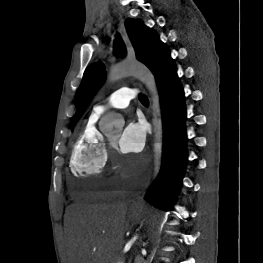 File:Cardiac tumor - undifferentiated pleomorphic sarcoma (Radiopaedia 45844-50134 B 33).png