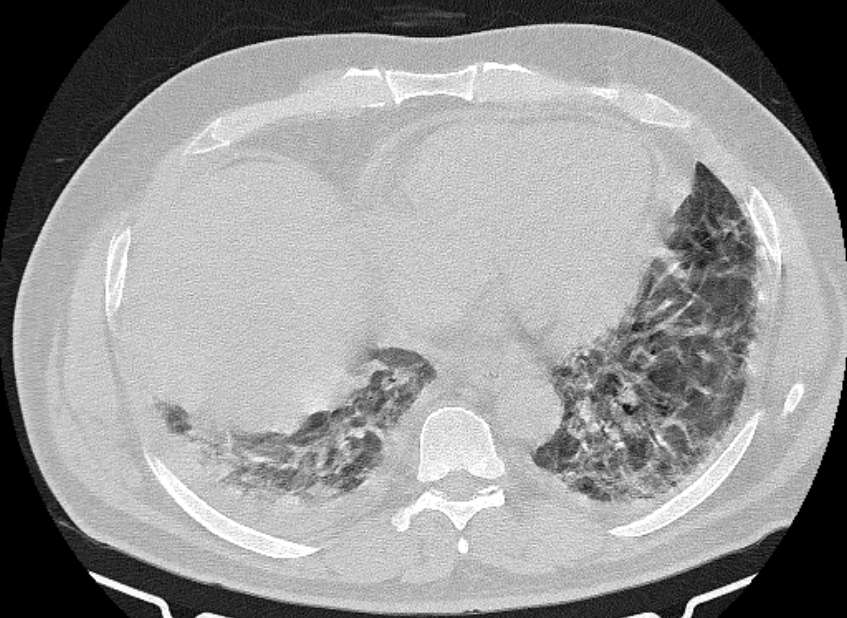 Cardiogenic pulmonary edema (Radiopaedia 68180-77678 Axial lung window 73).jpg