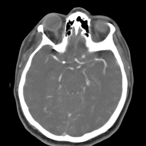 Carotico ophthalmic aneurysm (Radiopaedia 42916-46148 A 33).png