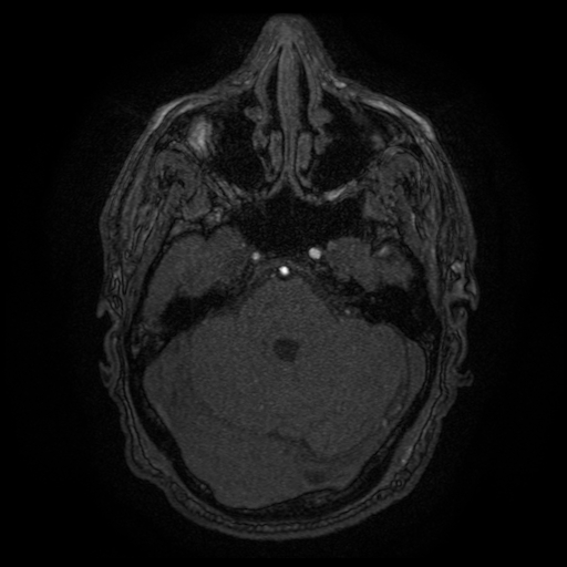 Carotid arterial dissection with acute cerebral infarction (Radiopaedia 26636-26784 MRA 126).jpg