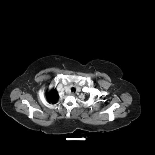File:Carotid body tumor (Radiopaedia 21021-20948 A 26).jpg